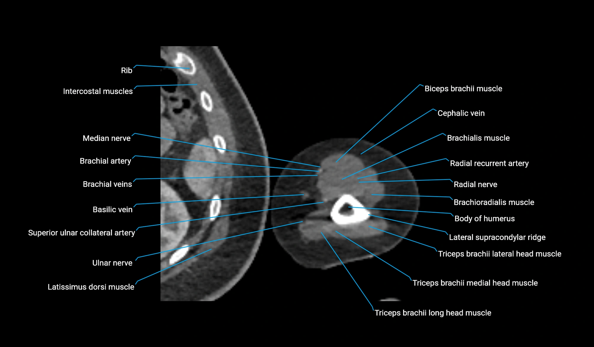 CT upper arm axial  cross sectional anatomy labelled radiology image -00338.webp